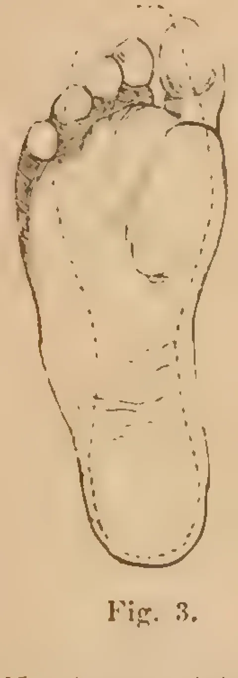 Fig. 3: Foot sole bottom view