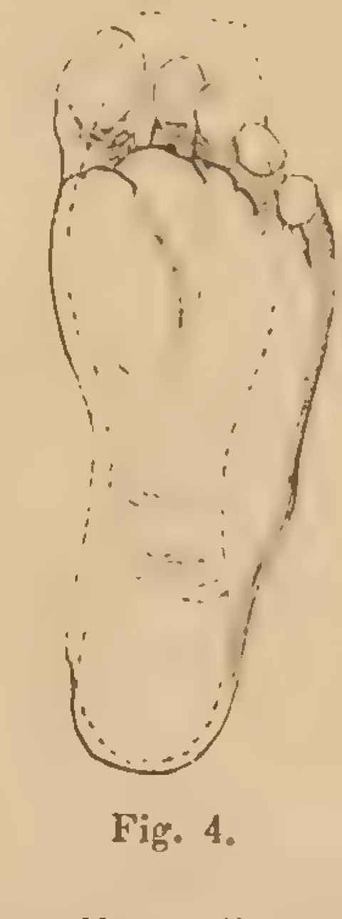 Fig. 4: Foot sole variant