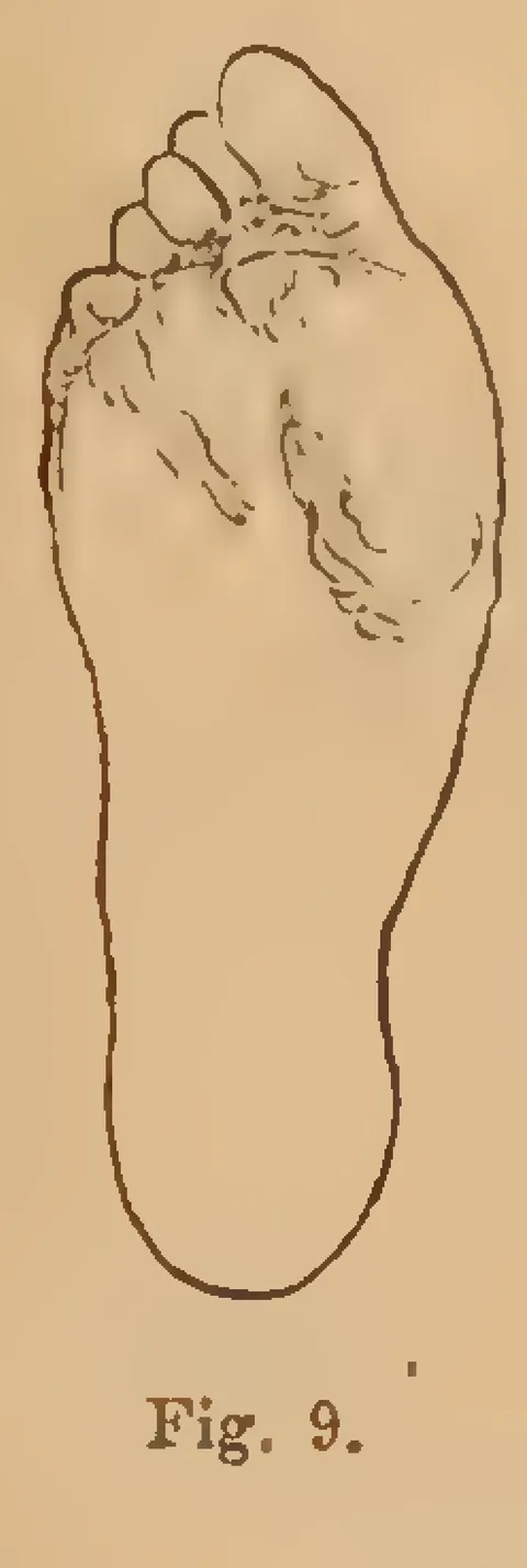 Fig. 9: Naturally formed foot