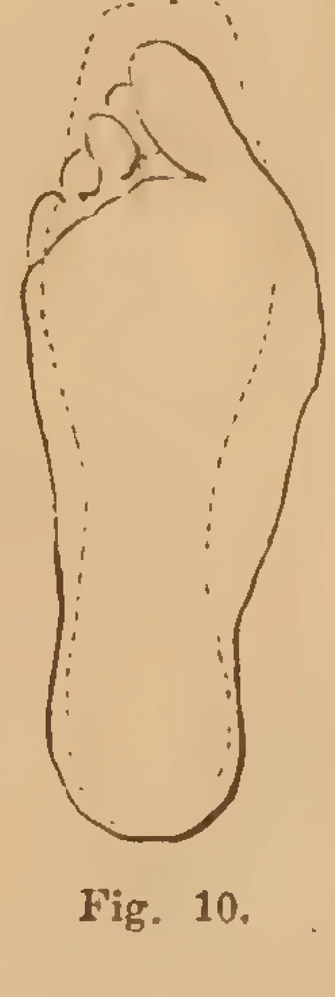 Fig. 10: Foot sole profile variant