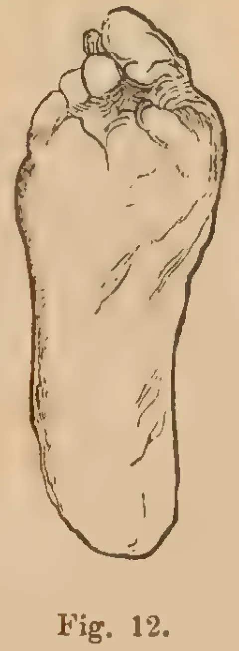 Fig. 12: Moderately deformed foot
