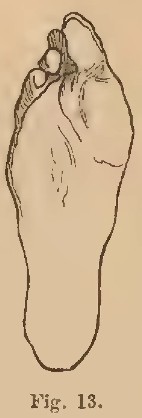 Fig. 13: Severely deformed foot