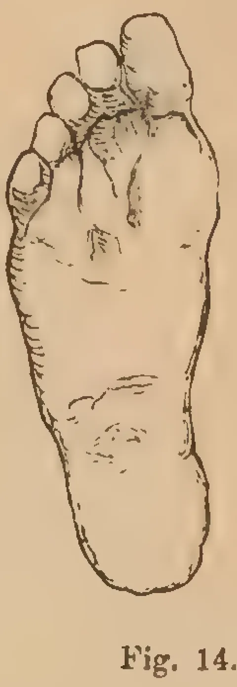 Fig. 14: Extreme foot deformation